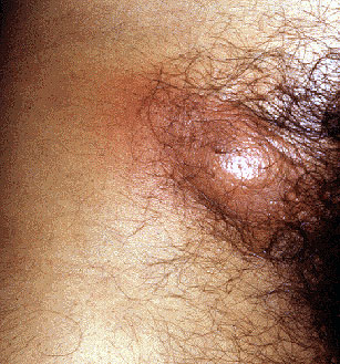 Воспаление паховых лимфоузлов при сифилисе