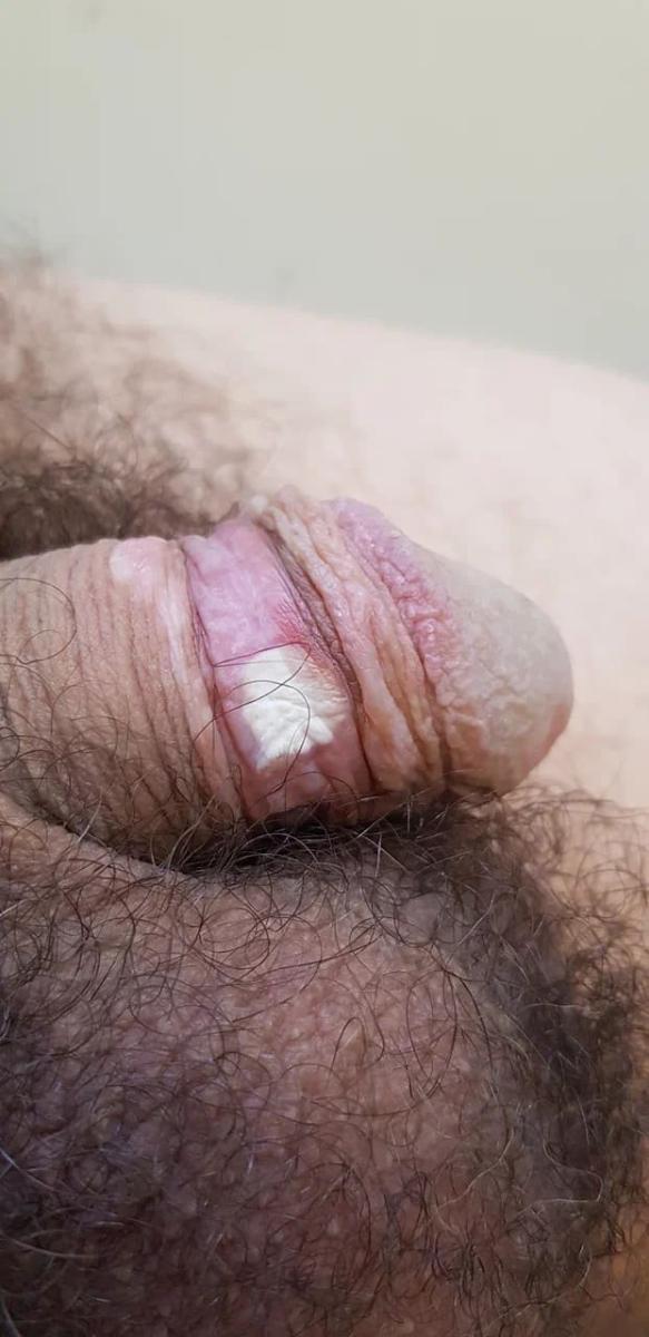 локализация кондилом локализация кондилом