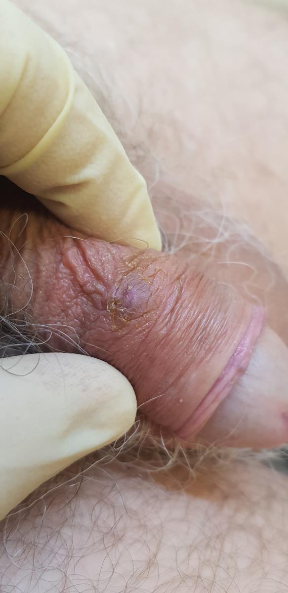 фолликулит при аллергии