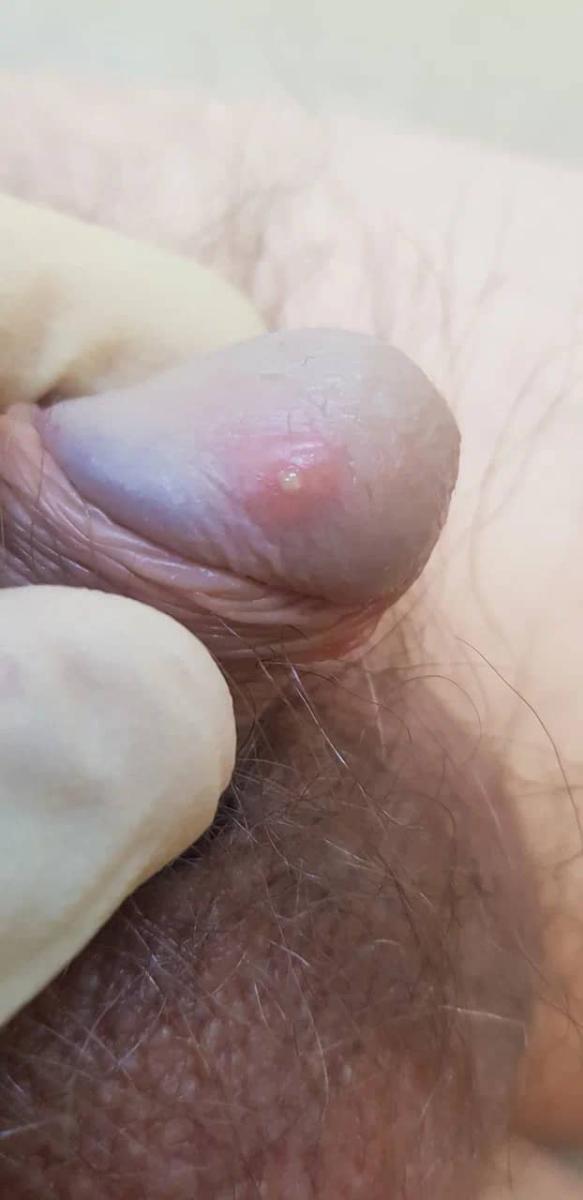 Пупырышки на головке полового члена