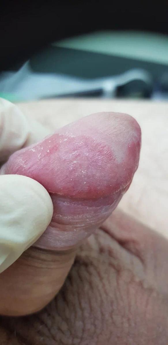 Язвы и эрозии 