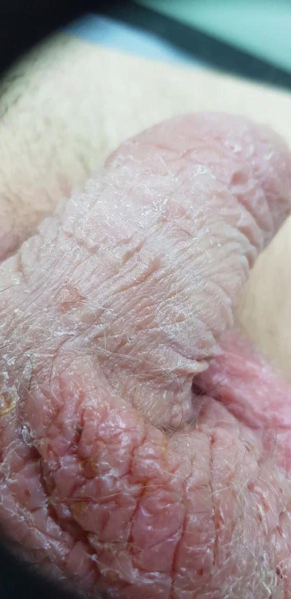 Псориаз Псориаз