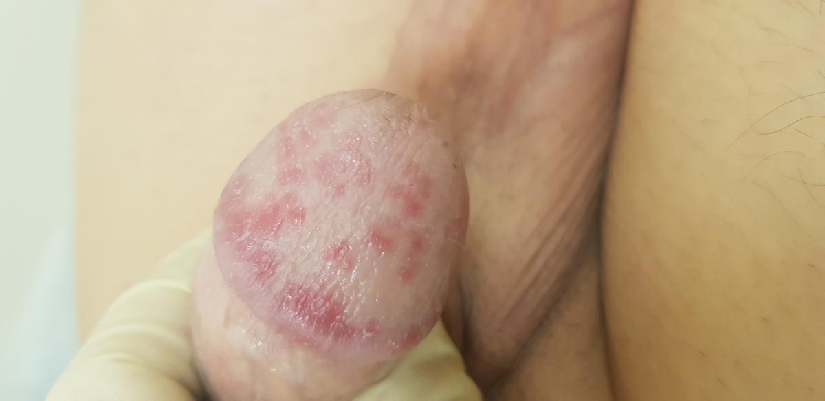 Стойкие красные пятна 