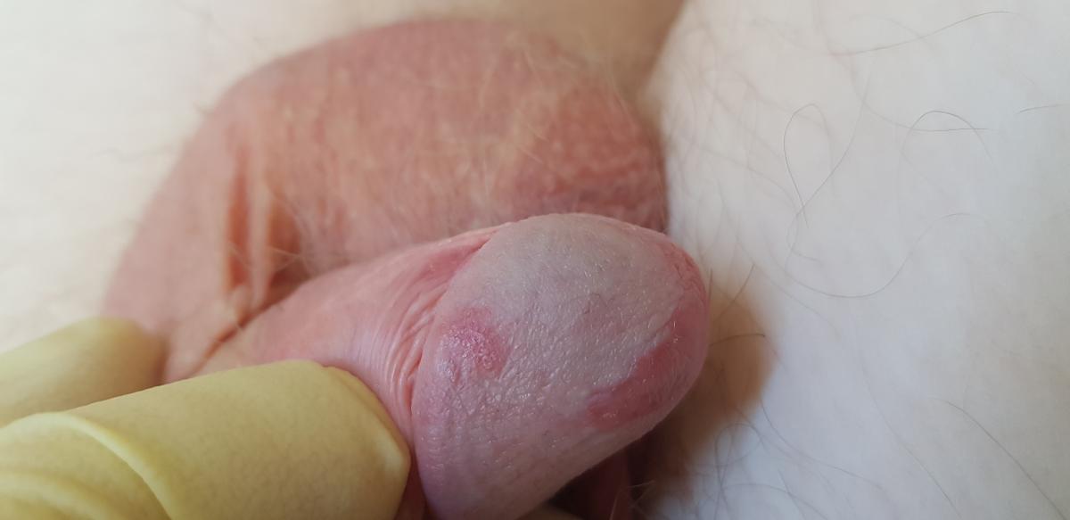 Приподнятые красные пятна на головке и плоти