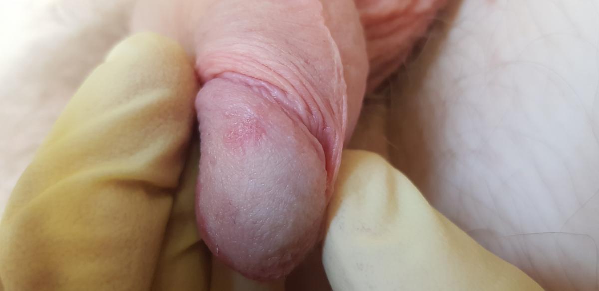 красные пятна на головке и плоти