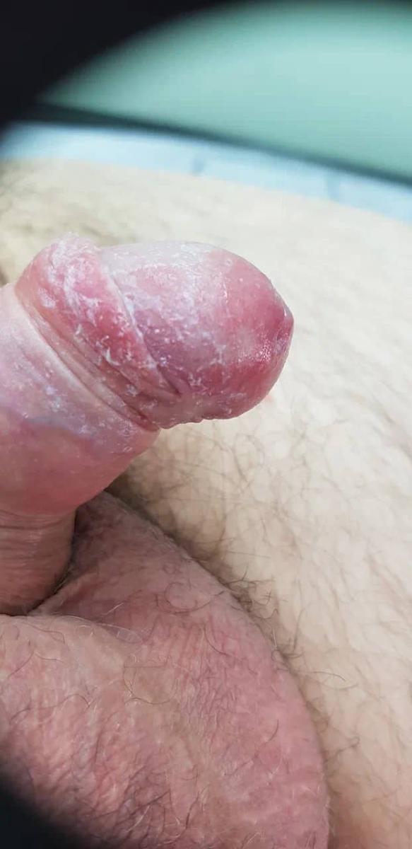 псориаз и кандида псориаз и кандида