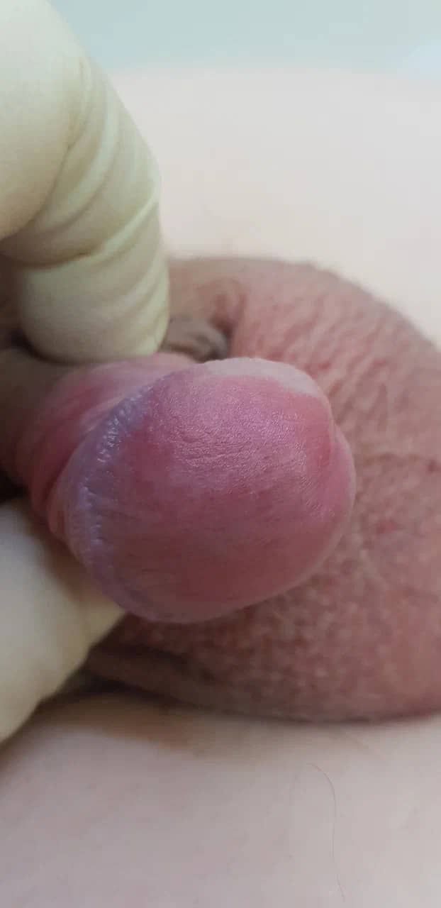 Дерматит на члене Воспаление кожи на члене