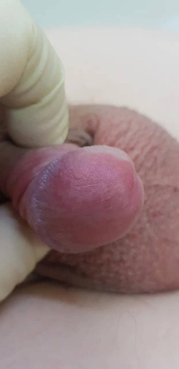 Дерматит на головке Простой контактный дерматит на головке члена