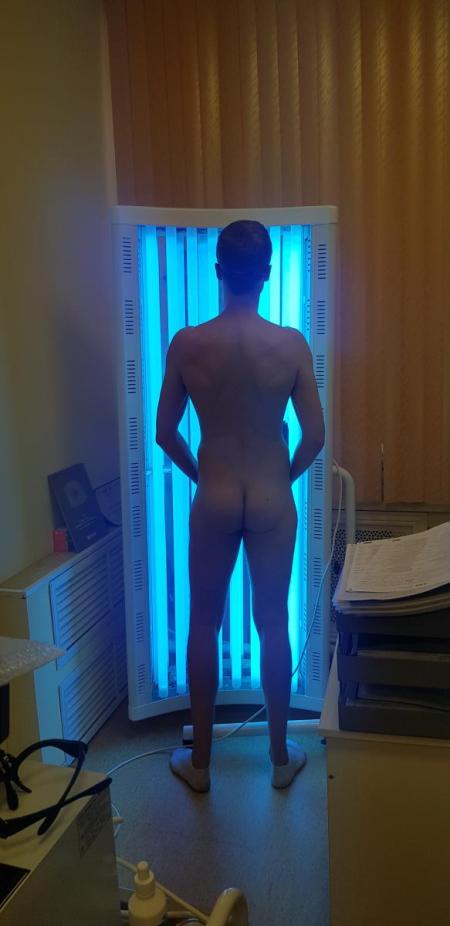 облучение-пува терапия пува терапия