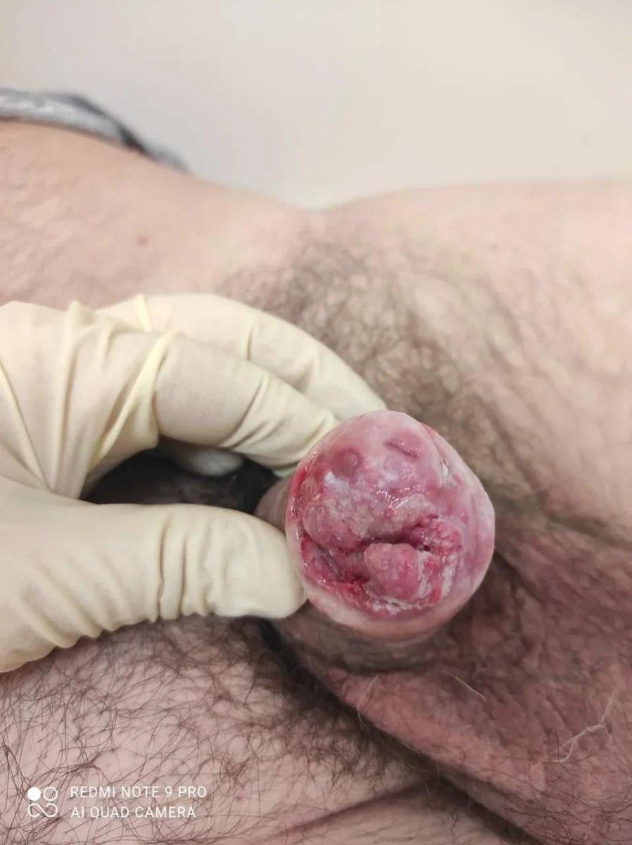 рак полового члена