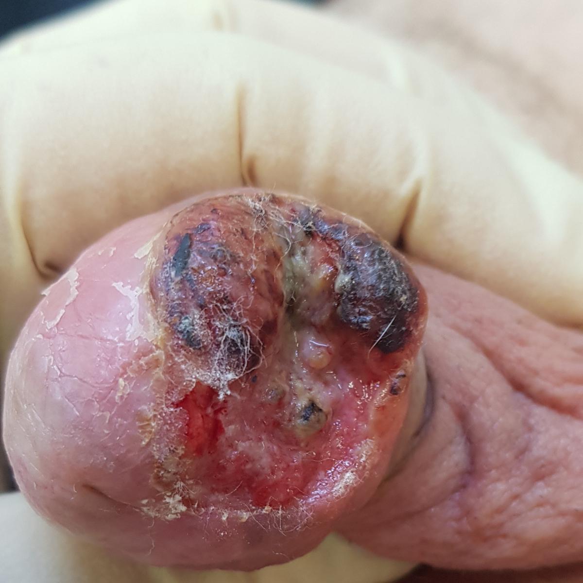 Рак головки члена Рак головки члена