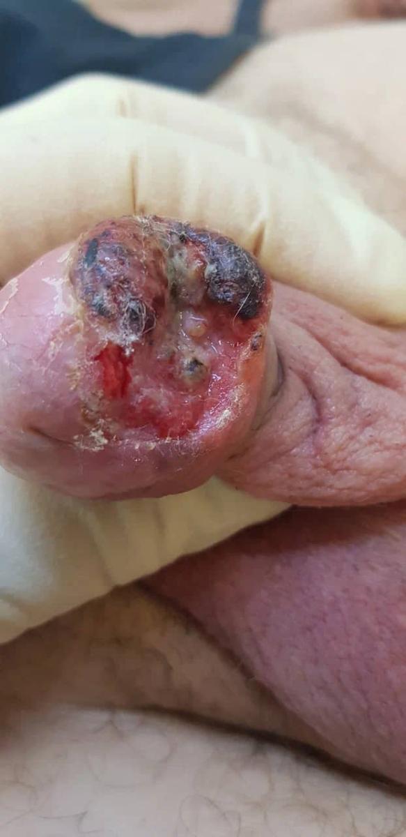 Признаки сифилиса на половом члене