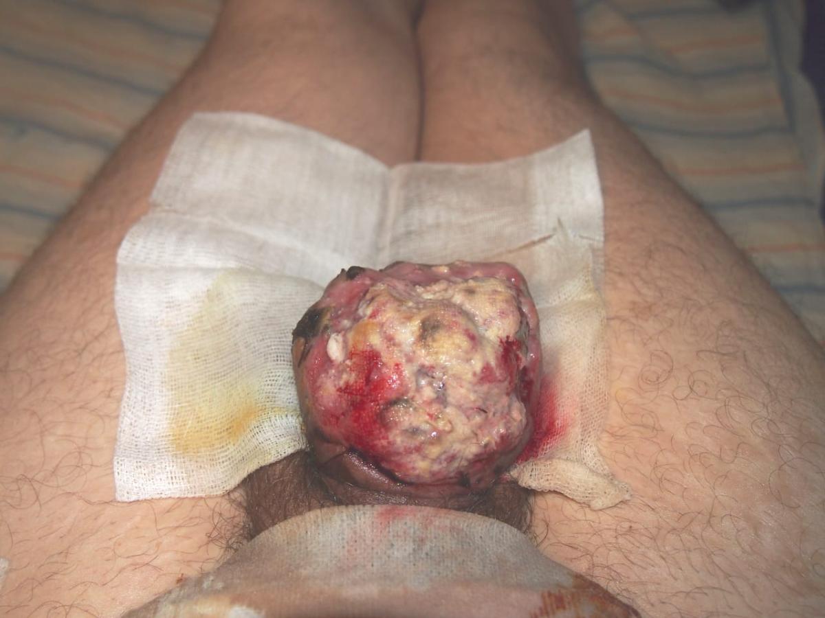 гнойный абсцесс