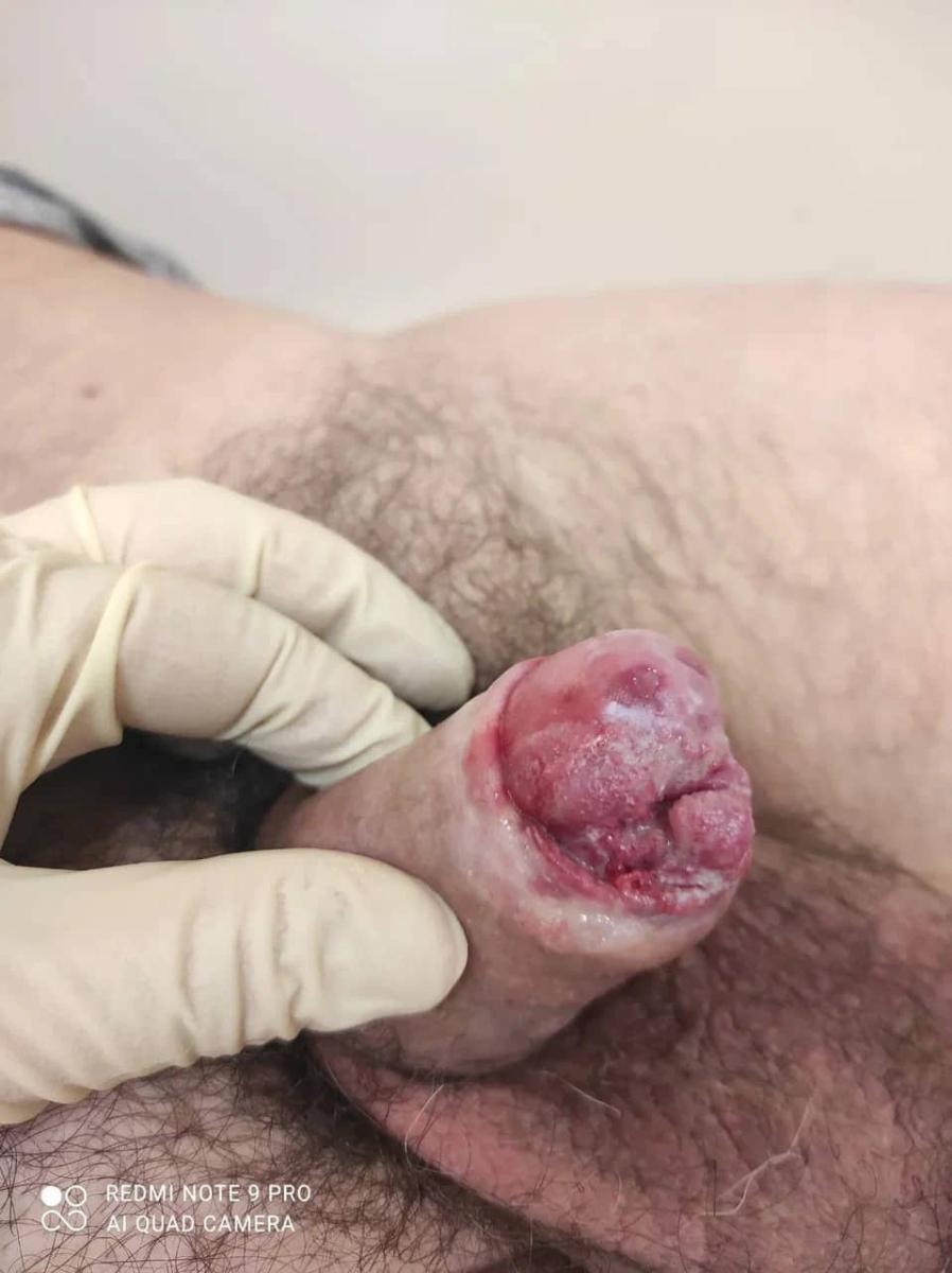 кондиломы и рак