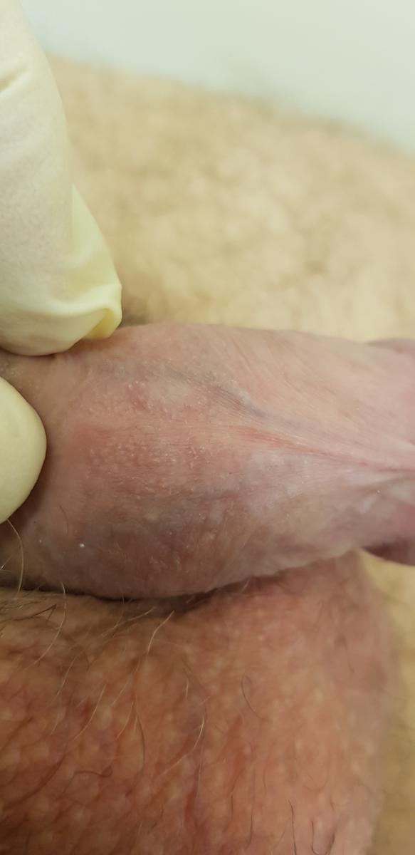 Гиперплазия сальных желез 