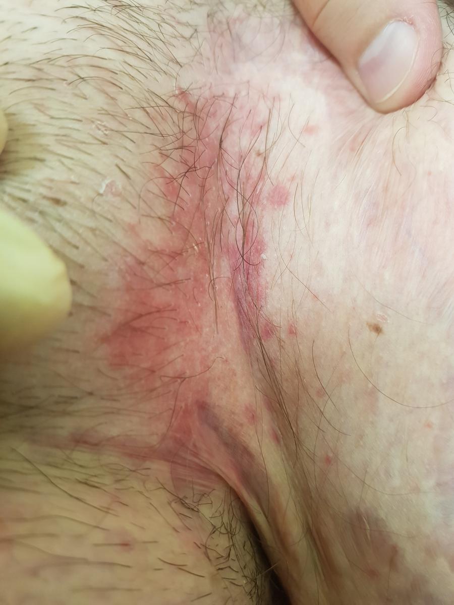 Пузырьки при контактном дерматите