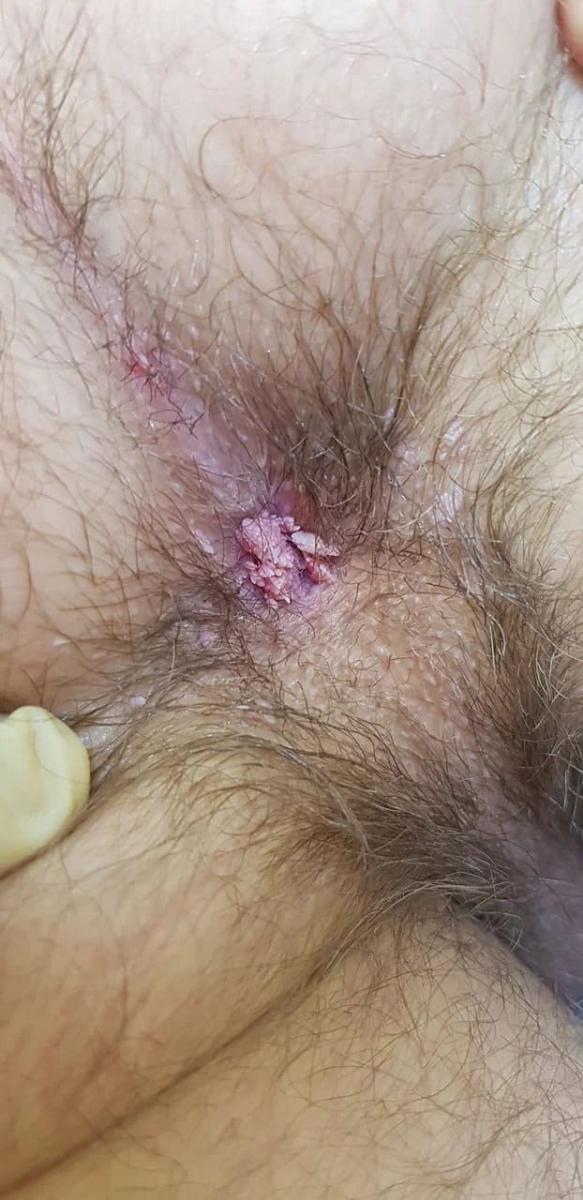 Кондиломы ануса