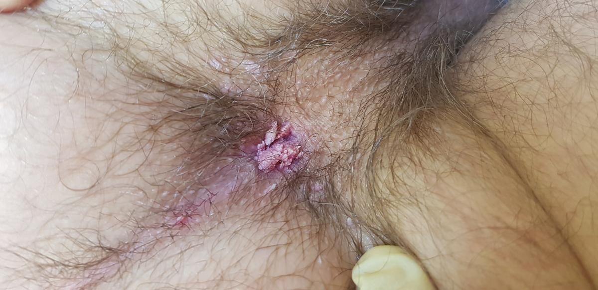 Терапия от кондилом впч