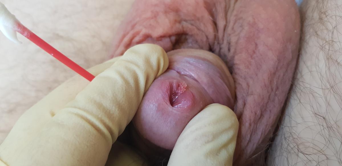 Рецидив кондилом 