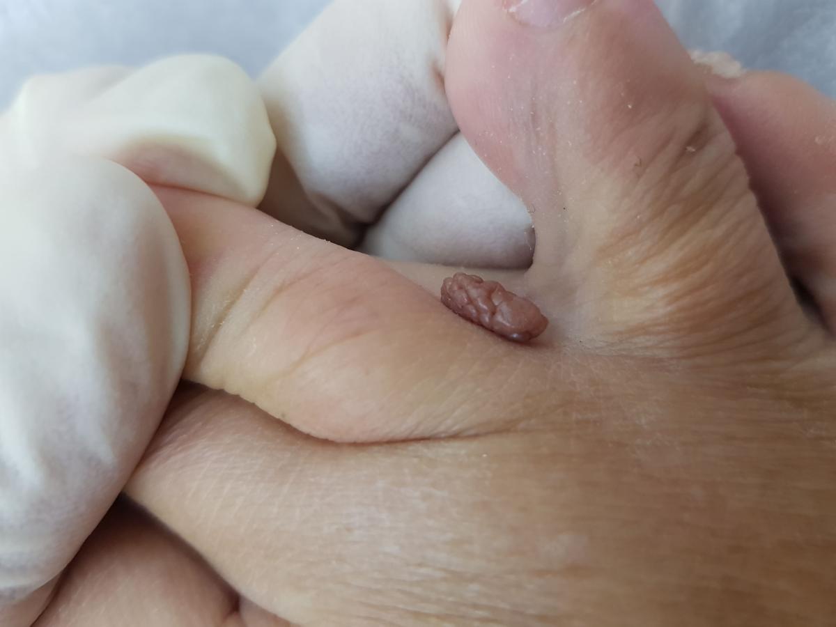 Родинка между пальцами ног Родинка между пальцами ног