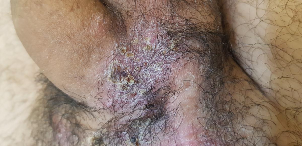 чешется лобок при герпесе