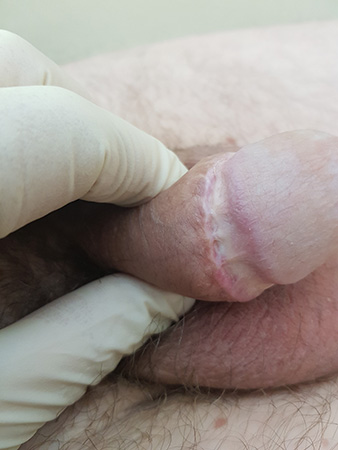 фото рубеца на крайней плоти после обрезания