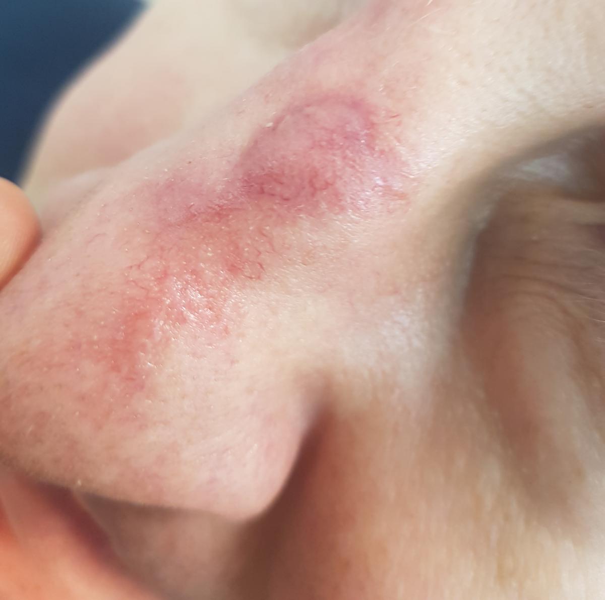 Рубец на носу Рубец на носу