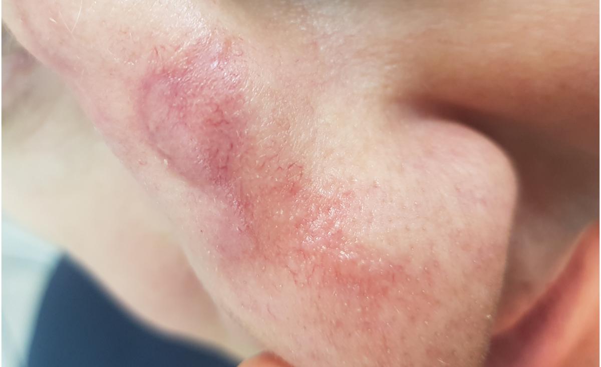 рубец на носу