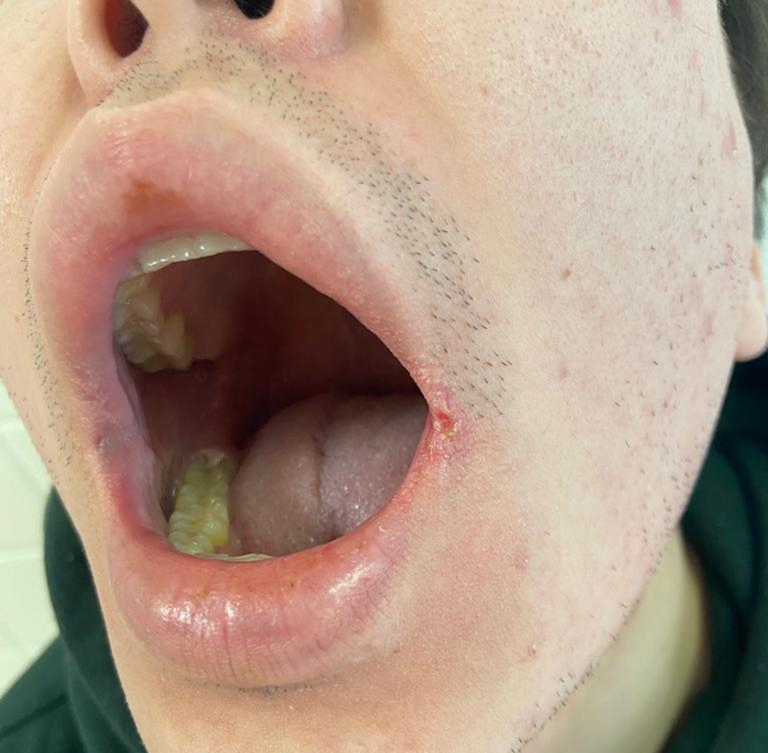 высыпания в горле при сифилисе