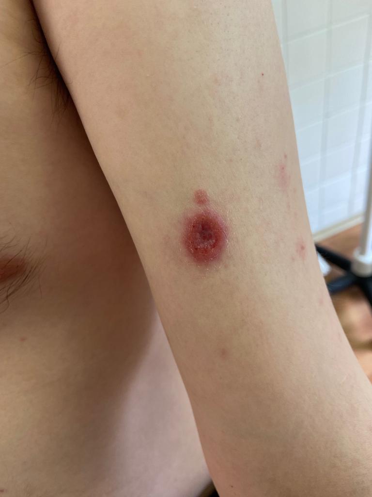 Моющие средства и губки Если кто-то из окружения болеет сифилисом, обычная гигиена поможет избежать заражения