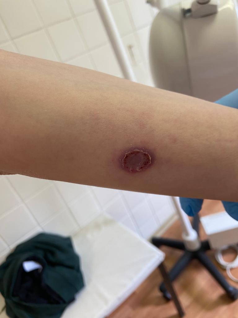 рупиоидный сифилис и шанкр шанкр