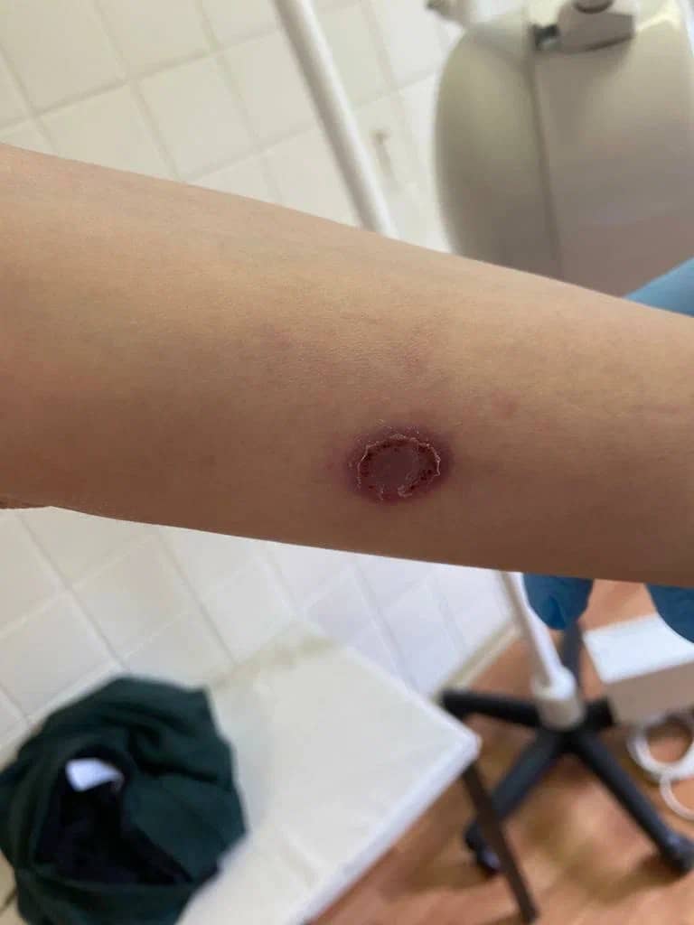 рупиоидный сифилис и шанкр