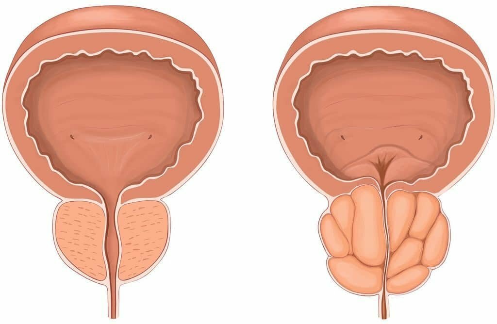 Здоровая простата и простатит