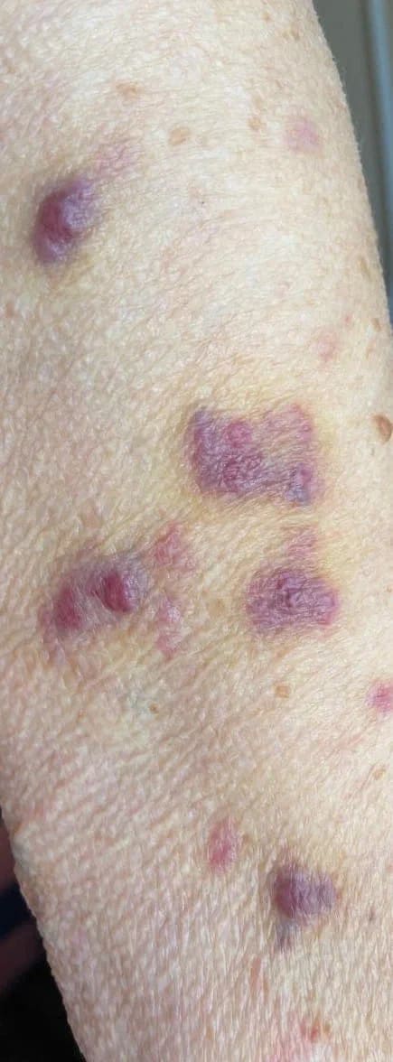 Саркома Капоши Саркома Капоши