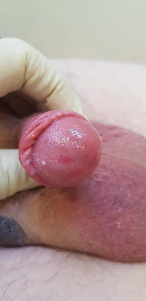 Обследование себорейная кератома, эритразма