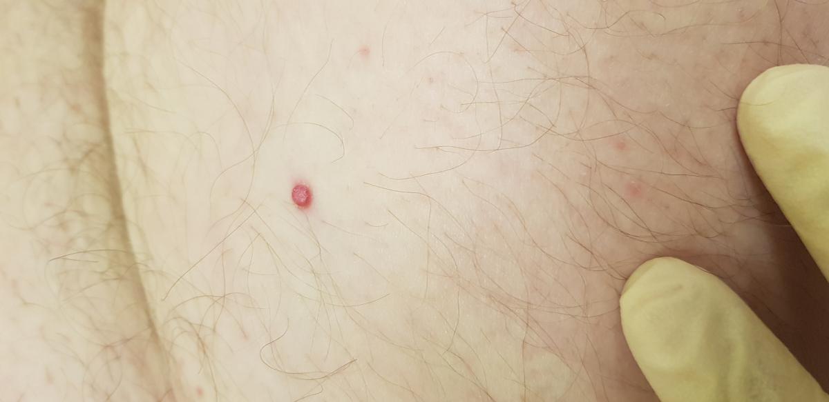 сенильная гемангиома