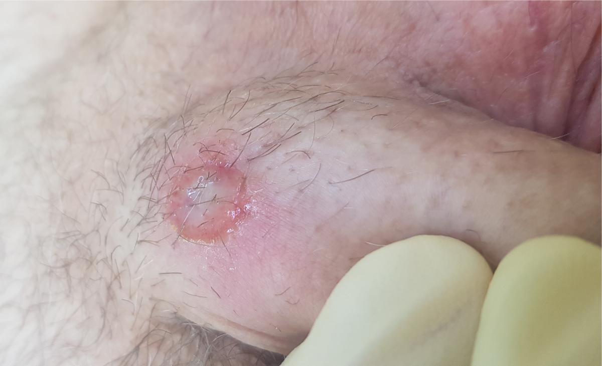 Шанкр на члене Шанкр на члене