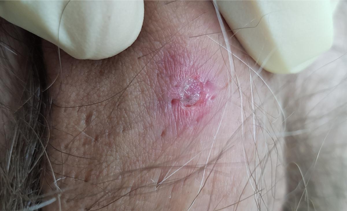 обнаружен сифилис симтомы сифилиса