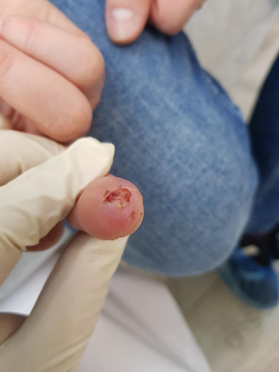 первичный сифилис