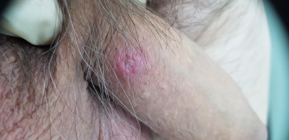 Болезнь сифилис проявляется появлением твердого шанкра