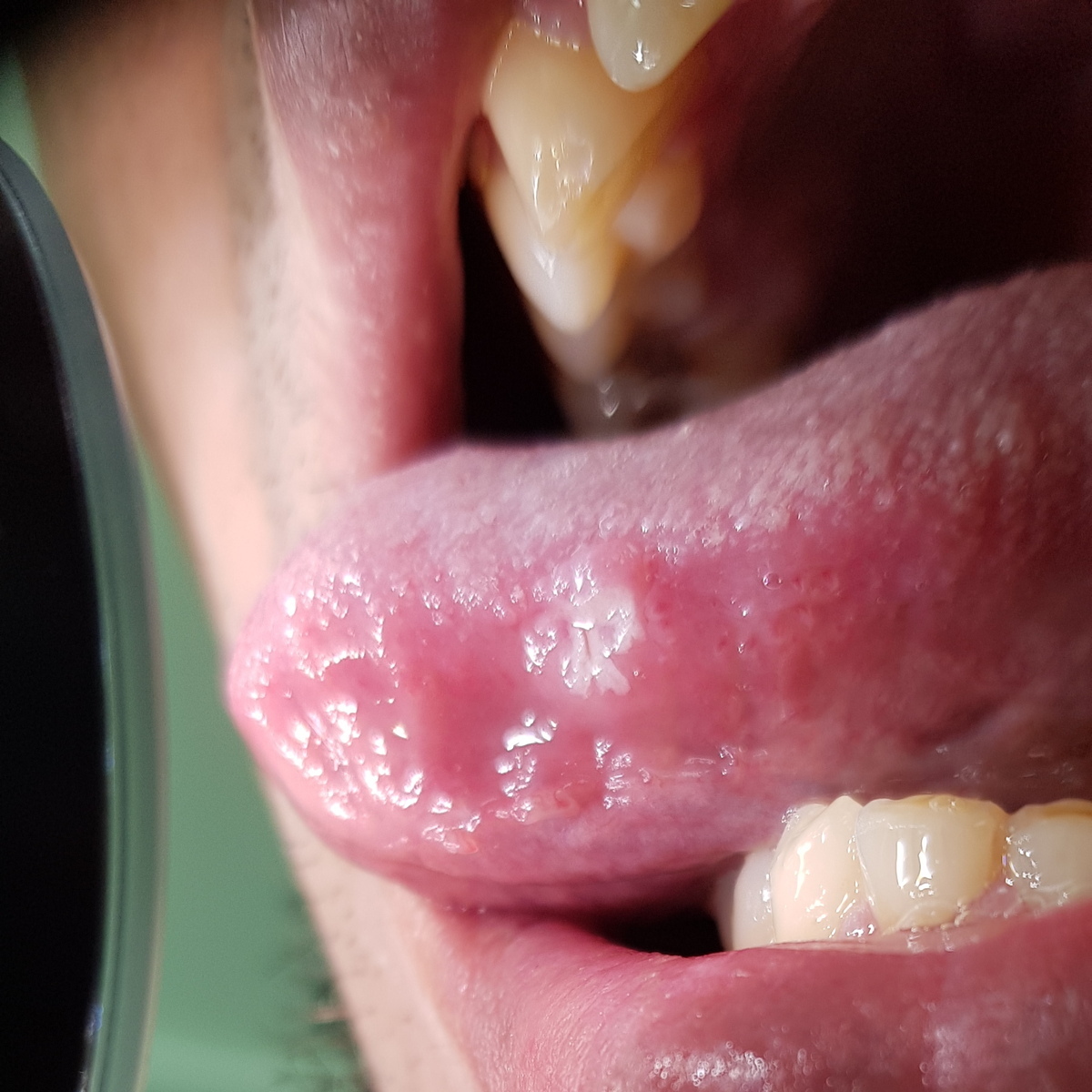 шанкры на языке