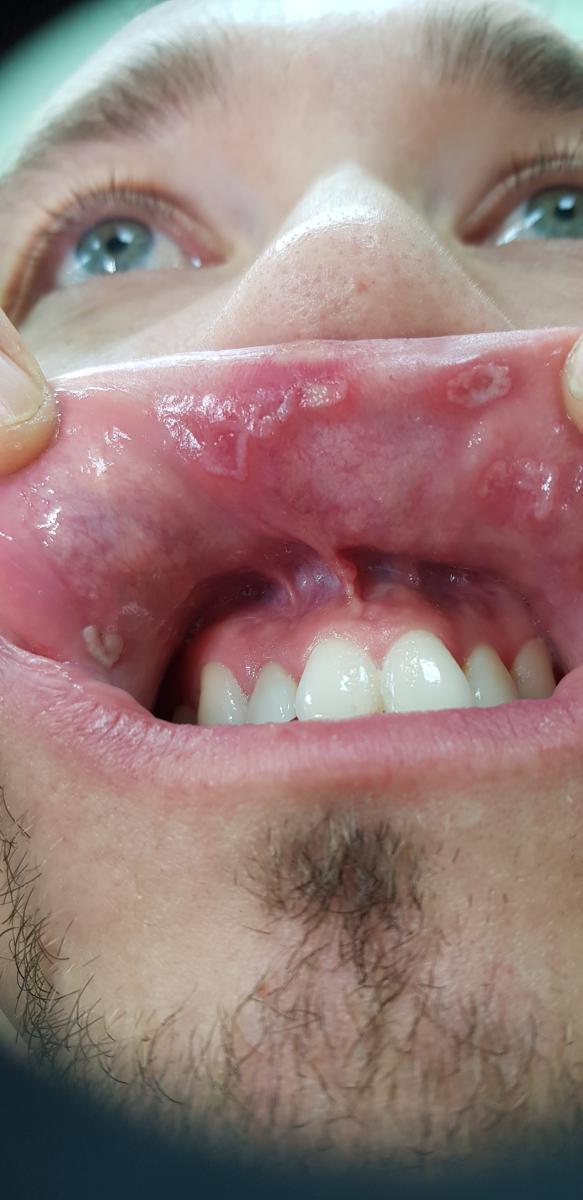 шанкры сифилис