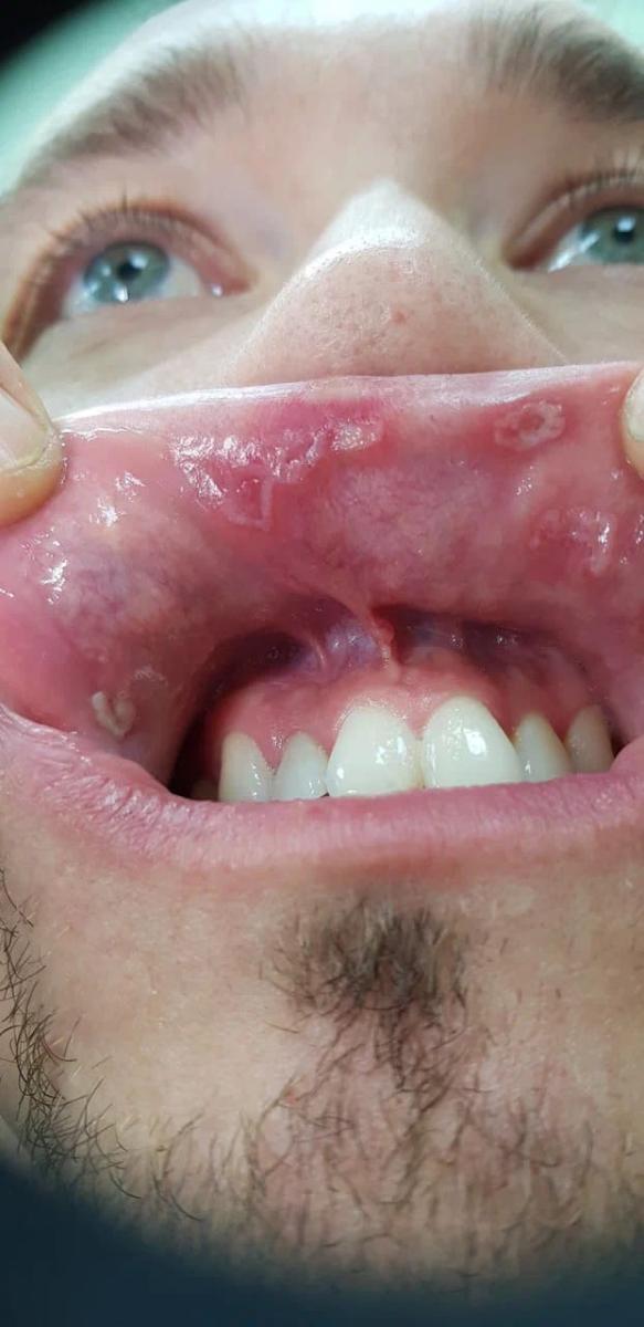 шанкры на губах