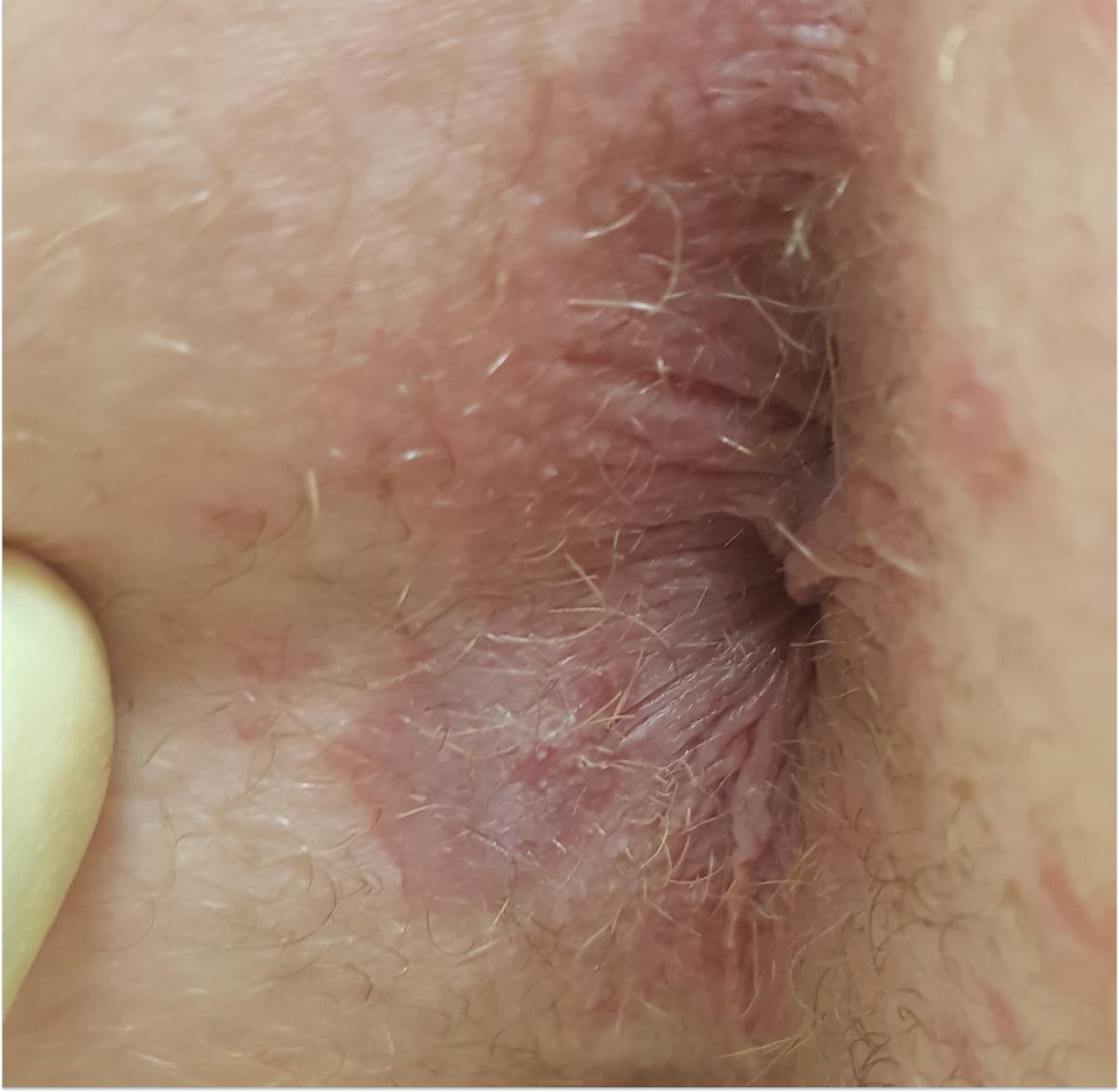 Симтомы сифилиса на анусе