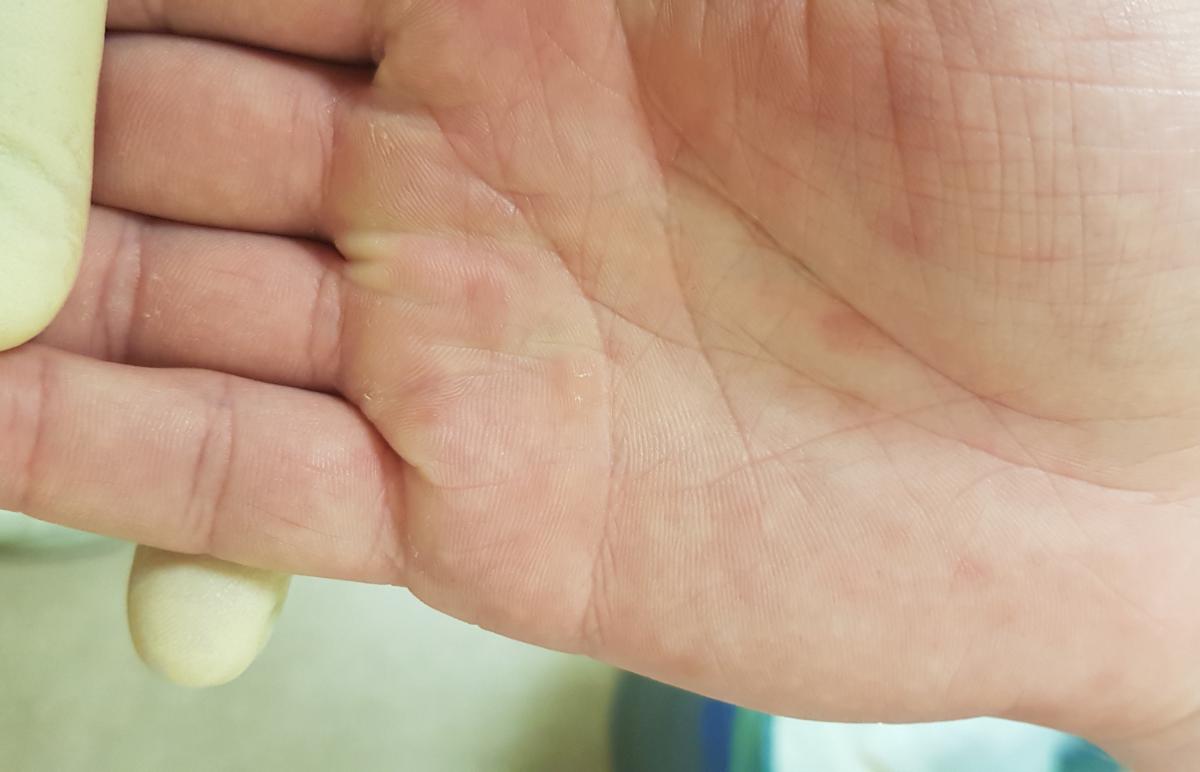 Симтомы сифилиса на руках