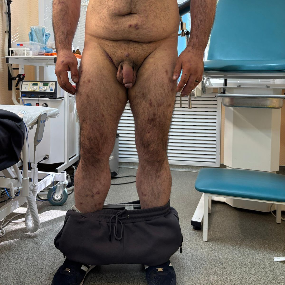 Симптомы сифилиса на теле Симптомы сифилиса на теле