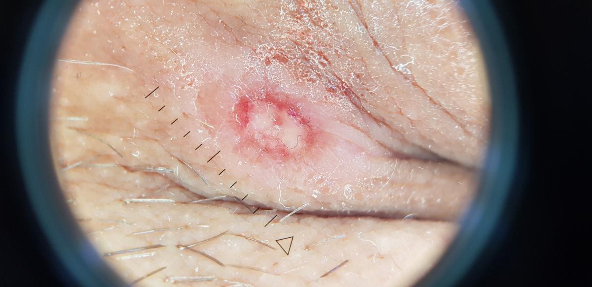 симптомы первичного сифилиса у женщин