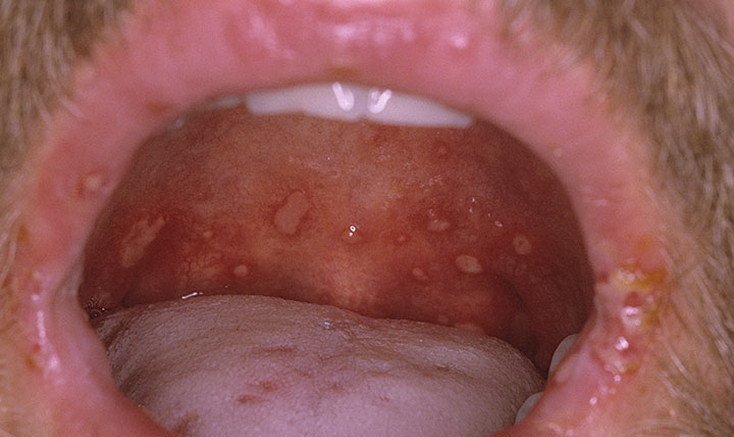 высыпания в горле при сифилисе