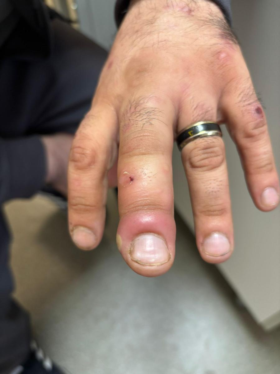 эктимы сифилис