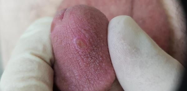 вздутие на головке при сифилисе 